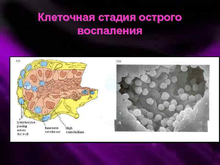 Клеточная стадия острого воспаления 