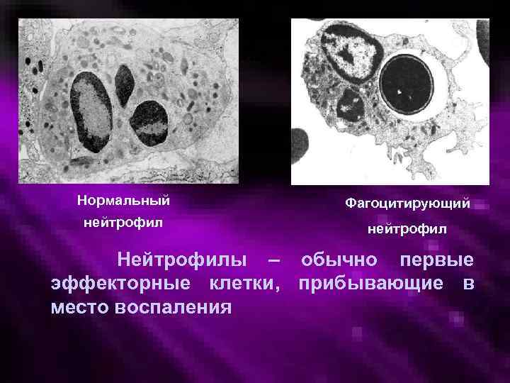 Фагоцитоз Нормальный Фагоцитирующий нейтрофил Нейтрофилы – обычно первые эффекторные клетки, прибывающие в место воспаления