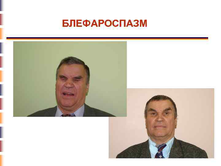 БЛЕФАРОСПАЗМ 