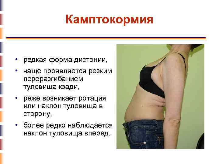 Камптокормия • редкая форма дистонии, • чаще проявляется резким переразгибанием туловища кзади, • реже