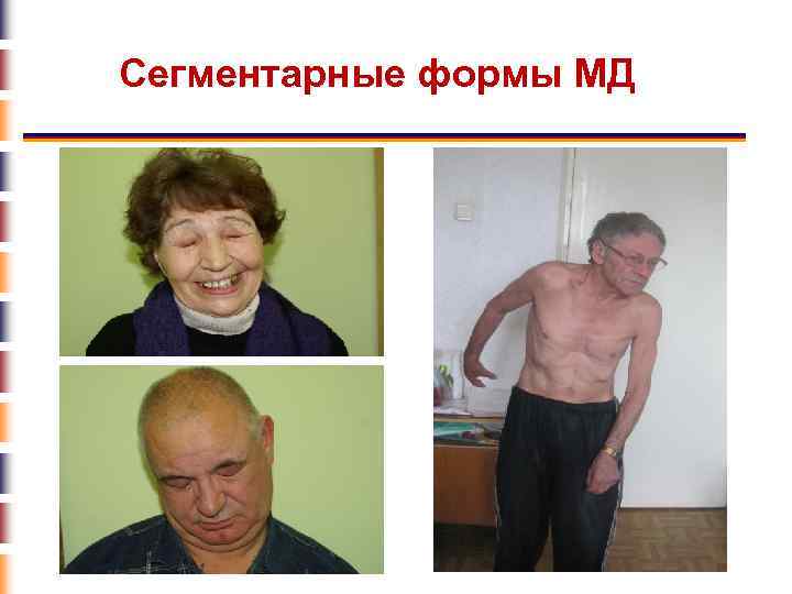 Сегментарные формы МД 