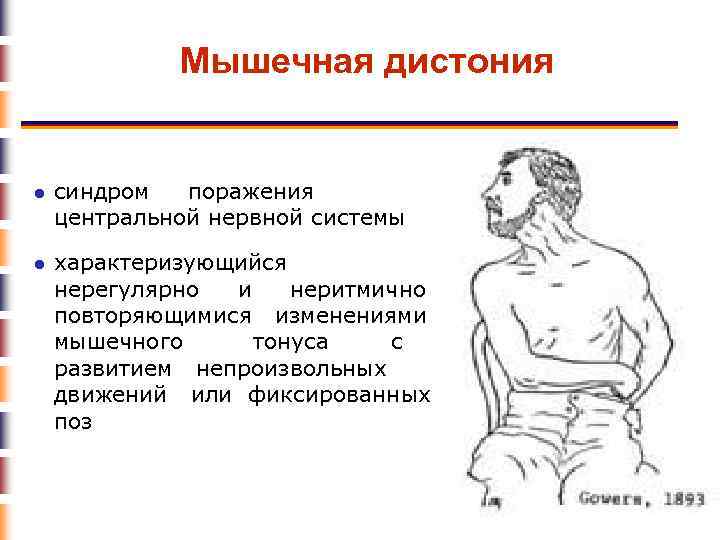 Мышечная дистония ● синдром поражения центральной нервной системы ● характеризующийся нерегулярно и неритмично повторяющимися