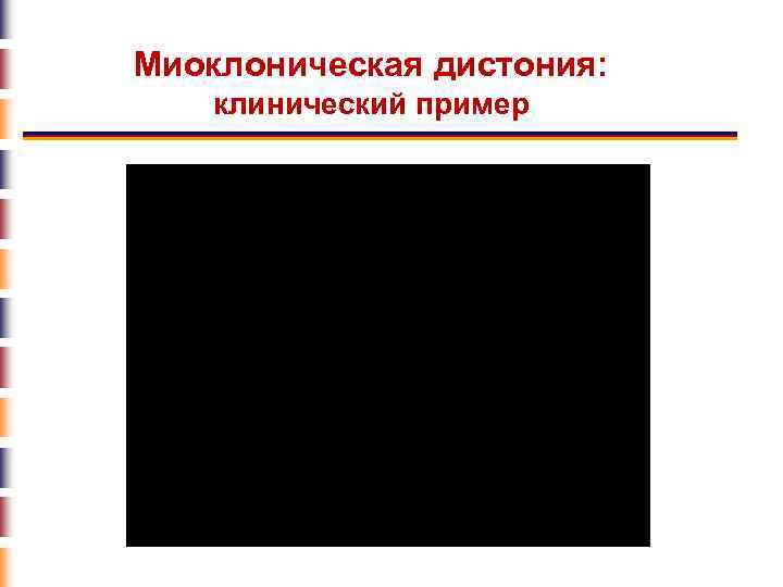 Миоклоническая дистония: клинический пример 