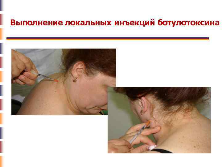 Выполнение локальных инъекций ботулотоксина 