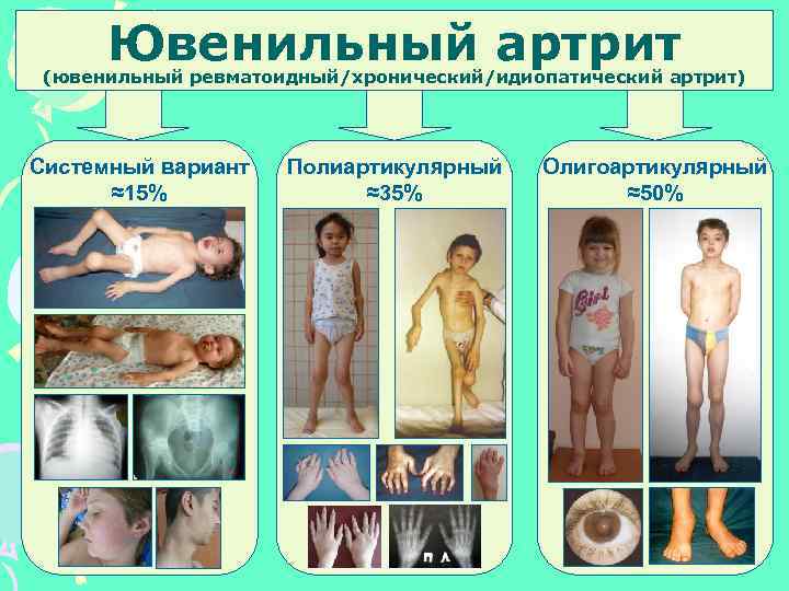 Ювенильный артрит (ювенильный ревматоидный/хронический/идиопатический артрит) Системный вариант ≈15% Полиартикулярный ≈35% Олигоартикулярный ≈50% 