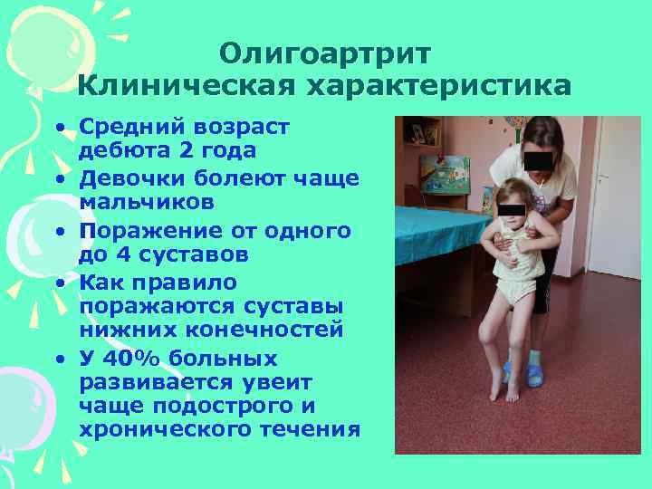 Олигоартрит Клиническая характеристика • Средний возраст дебюта 2 года • Девочки болеют чаще мальчиков