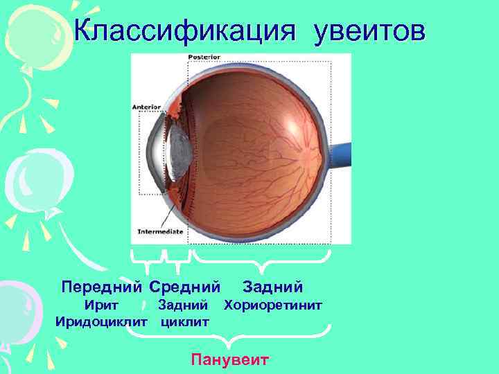 Классификация увеитов Передний Средний Ирит Задний Иридоциклит Задний Хориоретинит Панувеит 