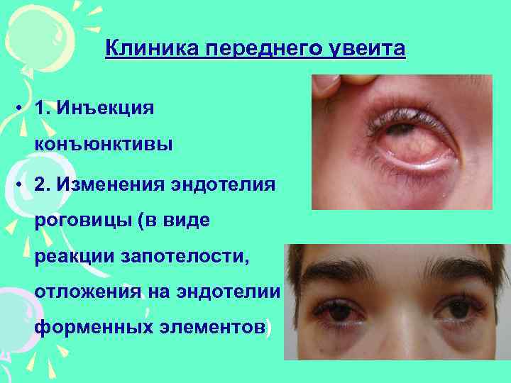 Клиника переднего увеита • 1. Инъекция конъюнктивы • 2. Изменения эндотелия роговицы (в виде