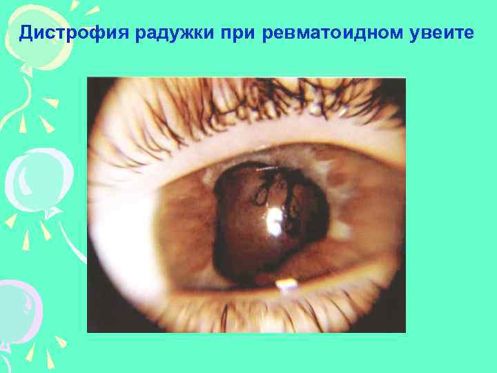 Дистрофия радужки при ревматоидном увеите 