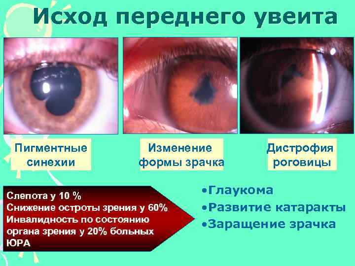 Исход переднего увеита Пигментные синехии Изменение формы зрачка Слепота у 10 % Снижение остроты