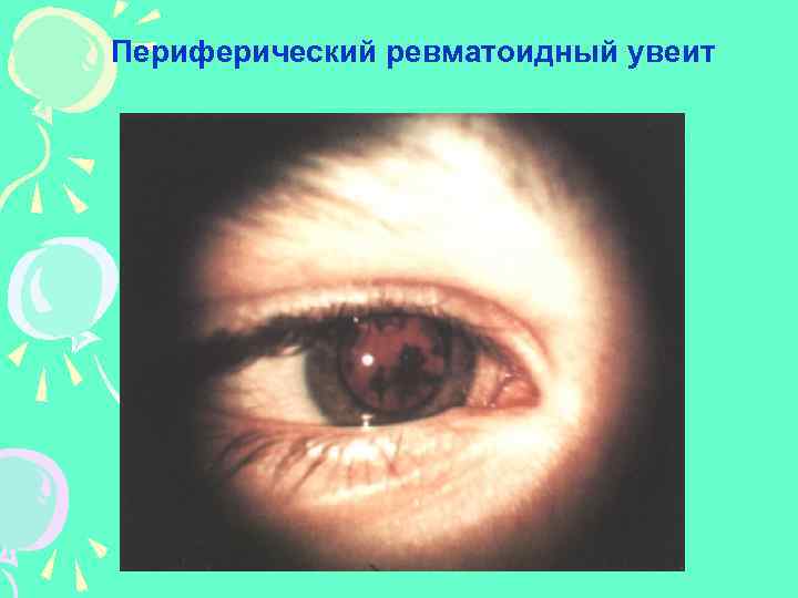 Периферический ревматоидный увеит 