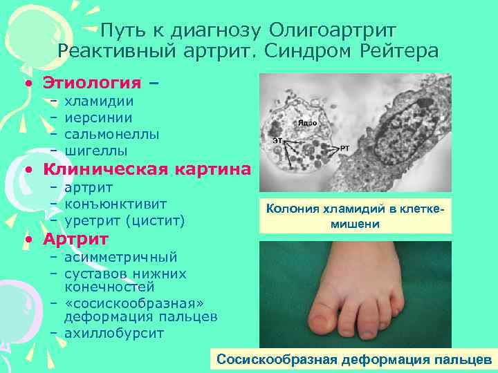 Путь к диагнозу Олигоартрит Реактивный артрит. Синдром Рейтера • Этиология – – – хламидии