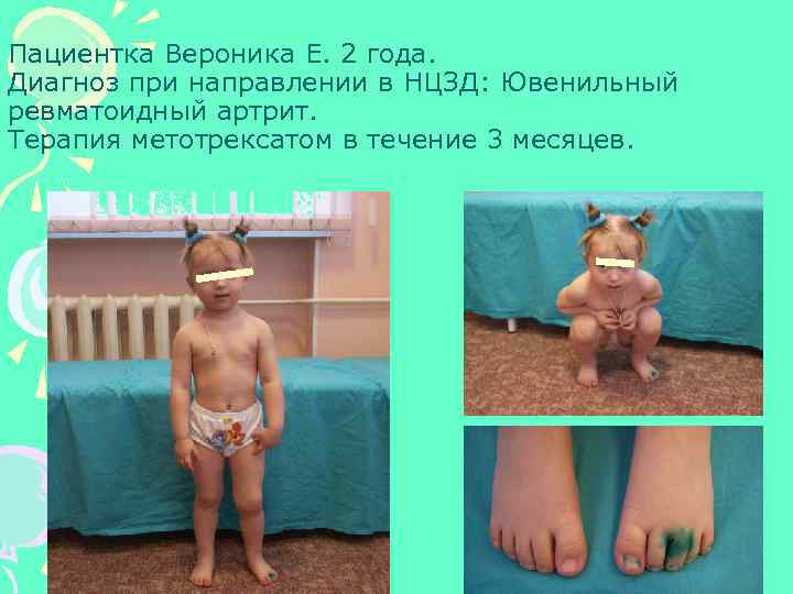 Пациентка Вероника Е. 2 года. Диагноз при направлении в НЦЗД: Ювенильный ревматоидный артрит. Терапия