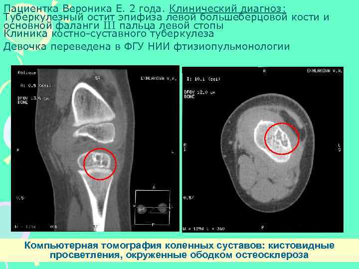 Пациентка Вероника Е. 2 года. Клинический диагноз: Туберкулезный остит эпифиза левой большеберцовой кости и