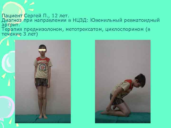 Пациент Сергей П. , 12 лет. Диагноз при направлении в НЦЗД: Ювенильный ревматоидный артрит.