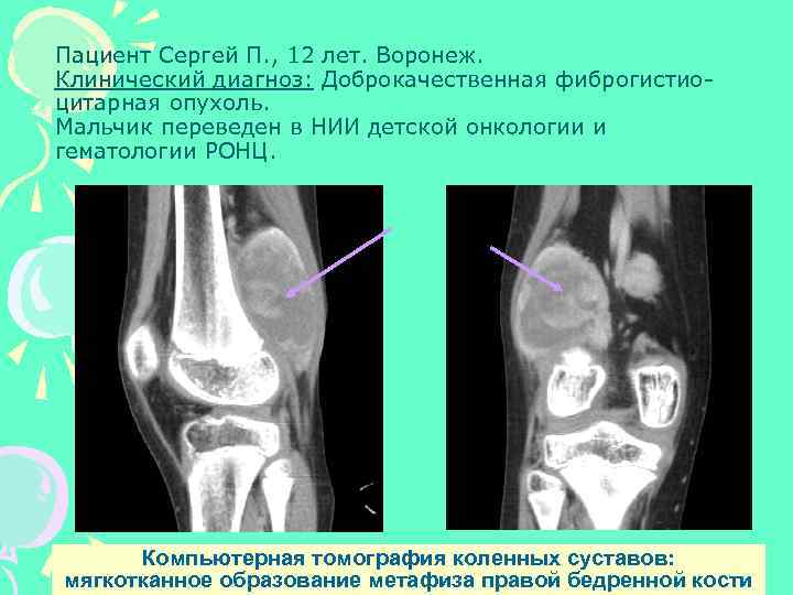 Пациент Сергей П. , 12 лет. Воронеж. Клинический диагноз: Доброкачественная фиброгистиоцитарная опухоль. Мальчик переведен
