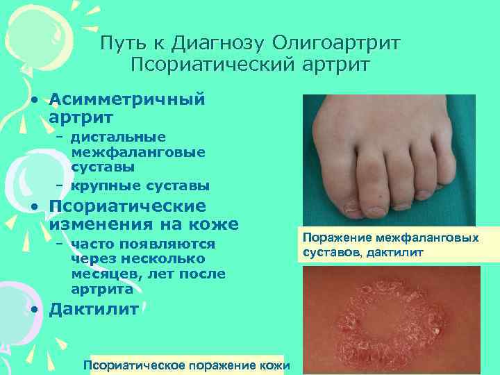 Путь к Диагнозу Олигоартрит Псориатический артрит • Асимметричный артрит – дистальные межфаланговые суставы –