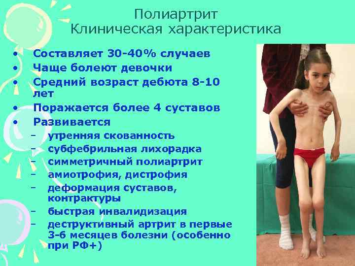 Полиартрит Клиническая характеристика • • • Составляет 30 -40% случаев Чаще болеют девочки Средний