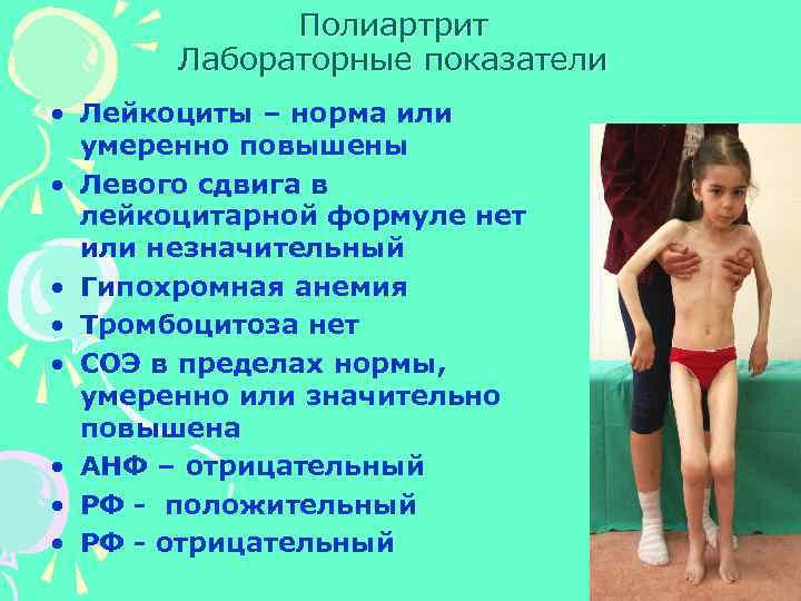 Полиартрит Лабораторные показатели • Лейкоциты – норма или умеренно повышены • Левого сдвига в