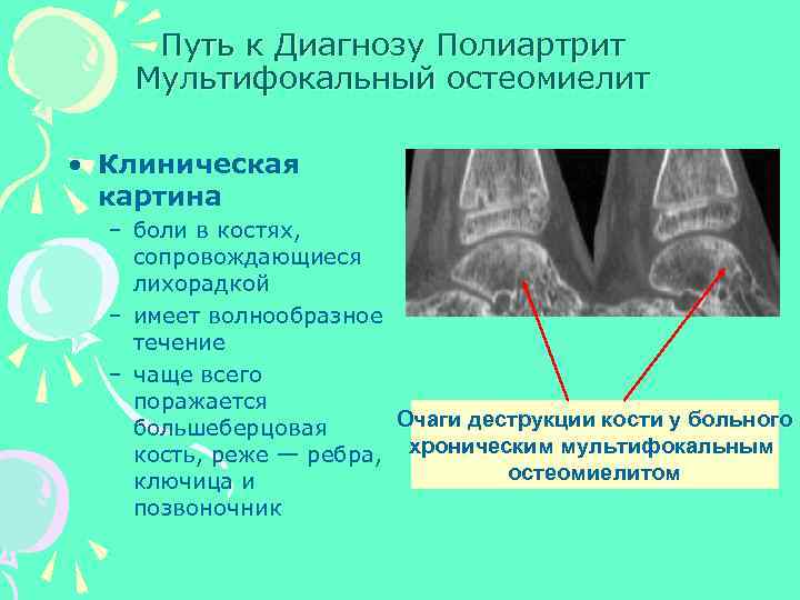 Путь к Диагнозу Полиартрит Мультифокальный остеомиелит • Клиническая картина – боли в костях, сопровождающиеся