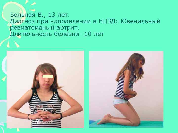 Больная В. , 13 лет. Диагноз при направлении в НЦЗД: Ювенильный ревматоидный артрит. Длительность
