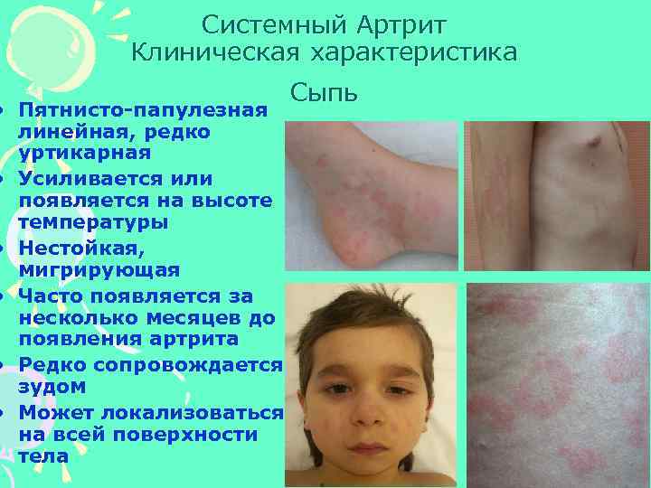 Системный Артрит Клиническая характеристика • Пятнисто-папулезная линейная, редко уртикарная • Усиливается или появляется на