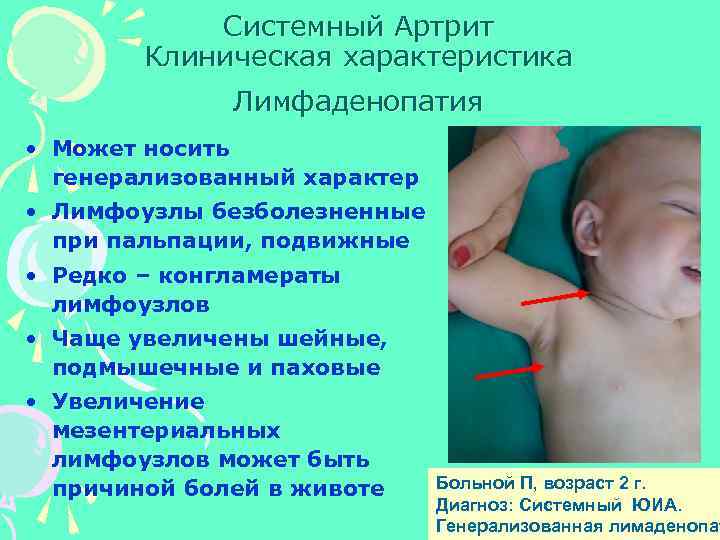 Системный Артрит Клиническая характеристика Лимфаденопатия • Может носить генерализованный характер • Лимфоузлы безболезненные при