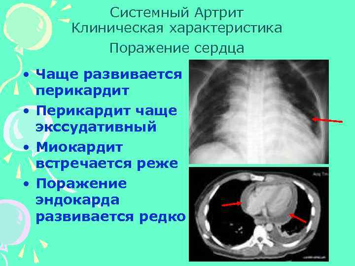 Системный Артрит Клиническая характеристика Поражение сердца • Чаще развивается перикардит • Перикардит чаще экссудативный