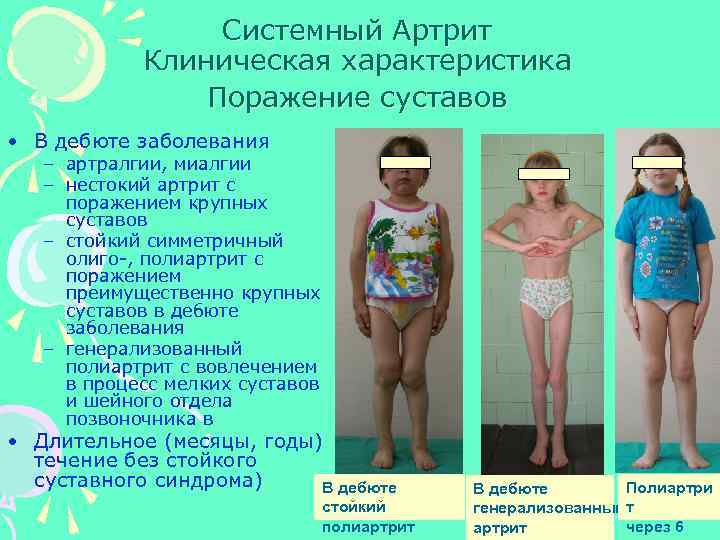 Системный Артрит Клиническая характеристика Поражение суставов • В дебюте заболевания – артралгии, миалгии –