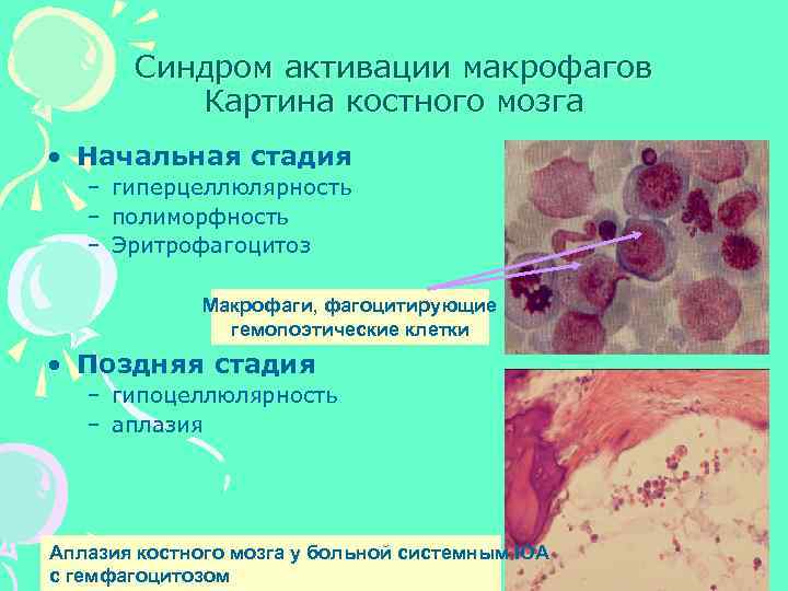 Синдром активации макрофагов Картина костного мозга • Начальная стадия – гиперцеллюлярность – полиморфность –