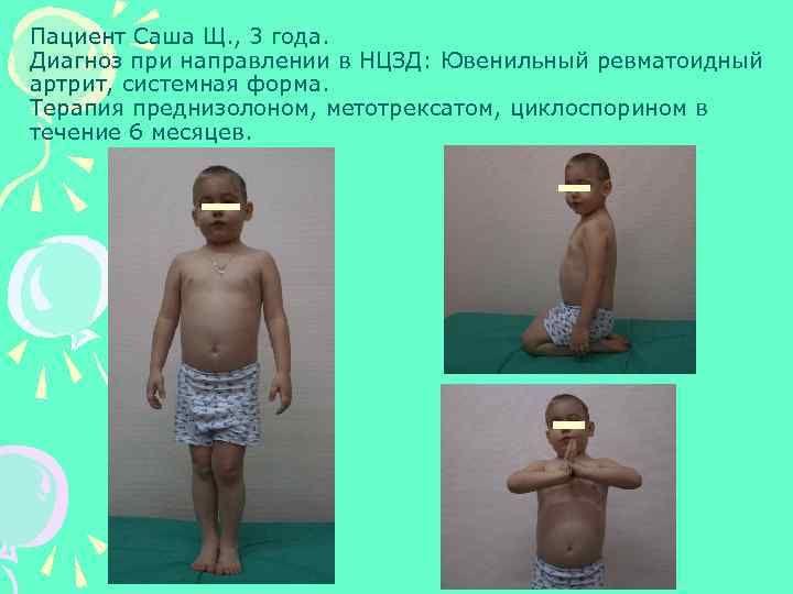 Пациент Саша Щ. , 3 года. Диагноз при направлении в НЦЗД: Ювенильный ревматоидный артрит,