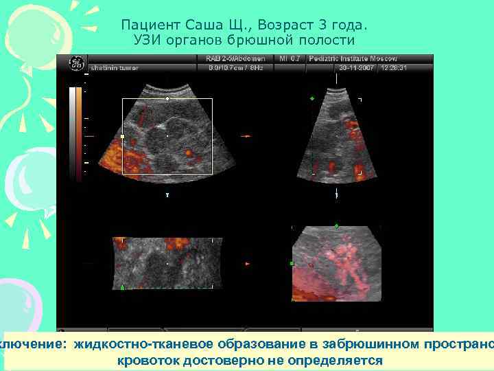 Пациент Саша Щ. , Возраст 3 года. УЗИ органов брюшной полости ключение: жидкостно-тканевое образование