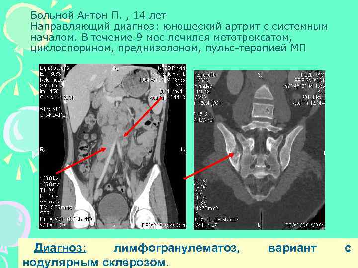Больной Антон П. , 14 лет Направляющий диагноз: юношеский артрит с системным началом. В