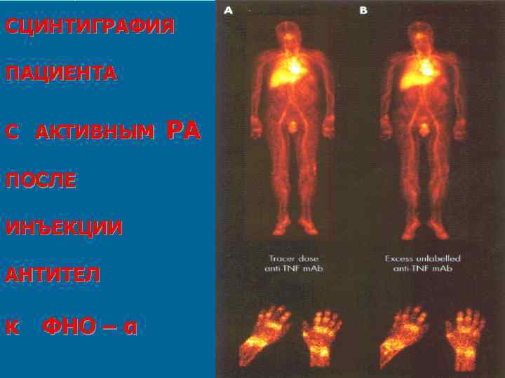 СЦИНТИГРАФИЯ ПАЦИЕНТА С АКТИВНЫМ ПОСЛЕ ИНЪЕКЦИИ АНТИТЕЛ К ФНО – α РА 