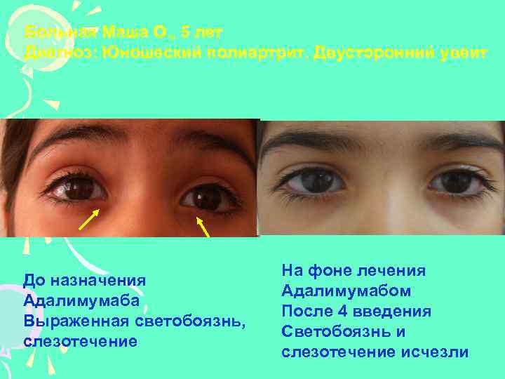 Больная Маша О. , 5 лет Диагноз: Юношеский полиартрит. Двусторонний увеит До назначения Адалимумаба