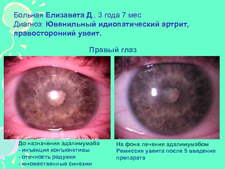 Больная Елизавета Д. , 3 года 7 мес Диагноз: Ювенильный идиопатический артрит, правосторонний увеит.