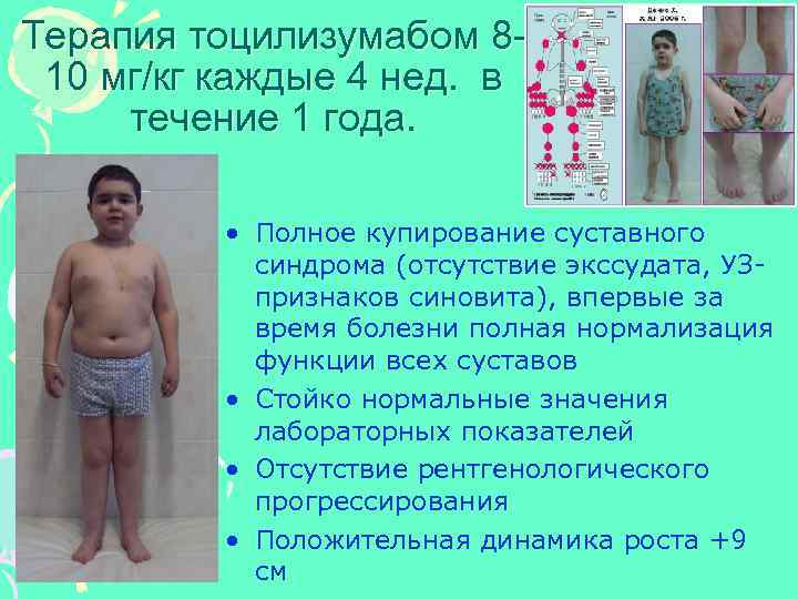 Терапия тоцилизумабом 810 мг/кг каждые 4 нед. в течение 1 года. • Полное купирование