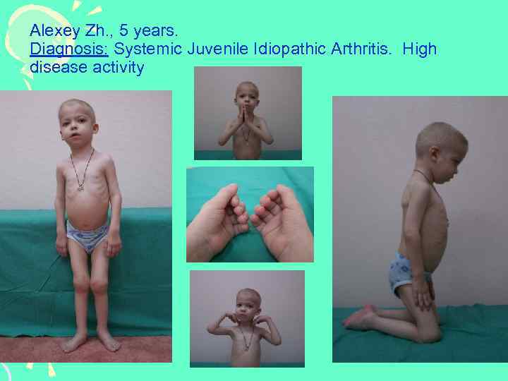 Alexey Zh. , 5 years. Diagnosis: Systemic Juvenile Idiopathic Arthritis. High A disease activity