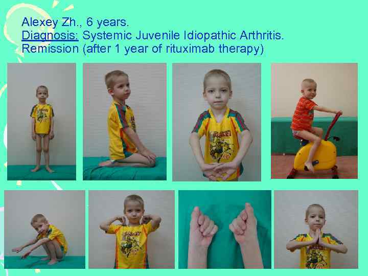Alexey Zh. , 6 years. Diagnosis: Systemic Juvenile Idiopathic Arthritis. A Remission (after 1