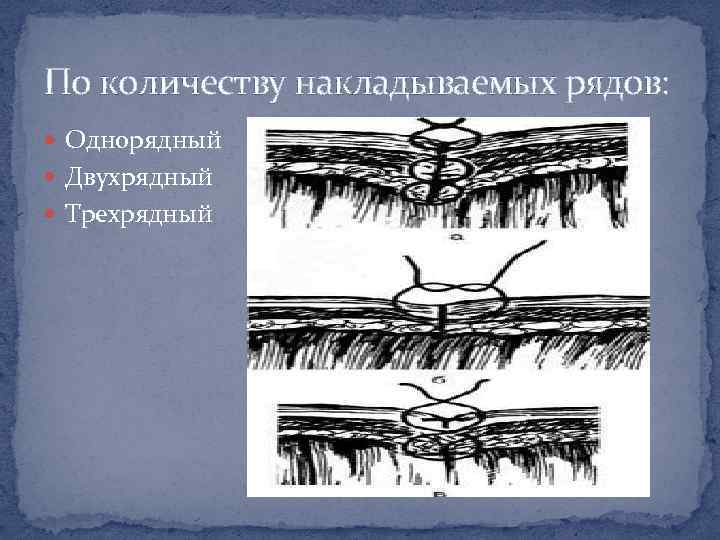 По количеству накладываемых рядов: Однорядный Двухрядный Трехрядный 