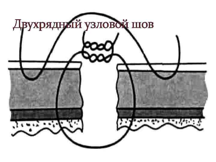 Двухрядный узловой шов 
