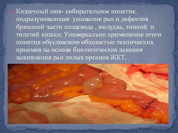  Кишечный шов- собирательное понятие, подразумевающее ушивание ран и дефектов брюшной части пищевода ,