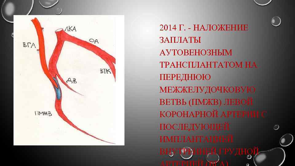 2014 Г. - НАЛОЖЕНИЕ ЗАПЛАТЫ АУТОВЕНОЗНЫМ ТРАНСПЛАНТАТОМ НА ПЕРЕДНЮЮ МЕЖЖЕЛУДОЧКОВУЮ ВЕТВЬ (ПМЖВ) ЛЕВОЙ КОРОНАРНОЙ