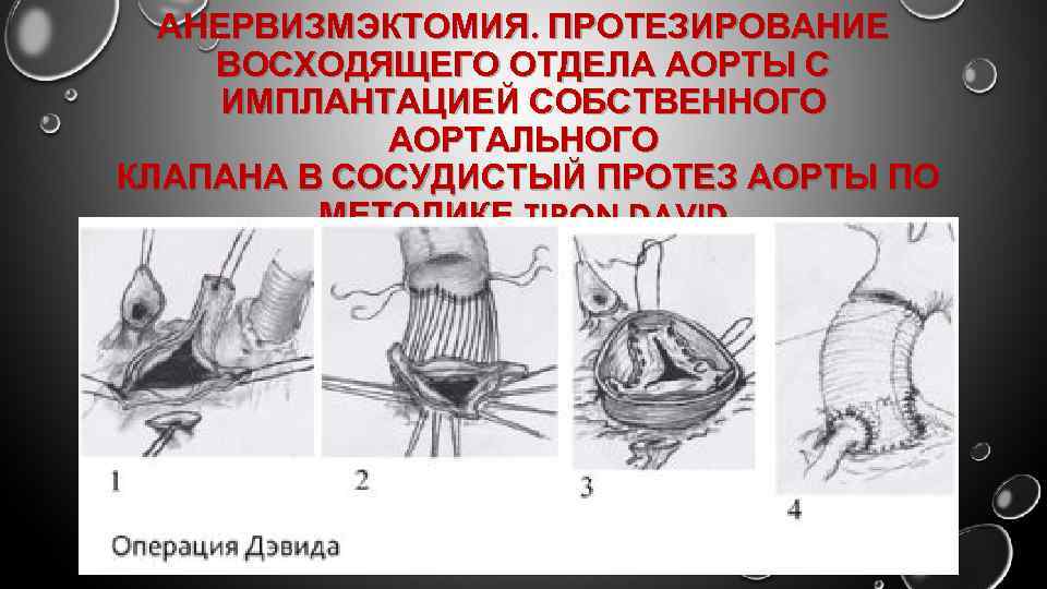 АНЕРВИЗМЭКТОМИЯ. ПРОТЕЗИРОВАНИЕ ВОСХОДЯЩЕГО ОТДЕЛА АОРТЫ С ИМПЛАНТАЦИЕЙ СОБСТВЕННОГО АОРТАЛЬНОГО КЛАПАНА В СОСУДИСТЫЙ ПРОТЕЗ АОРТЫ