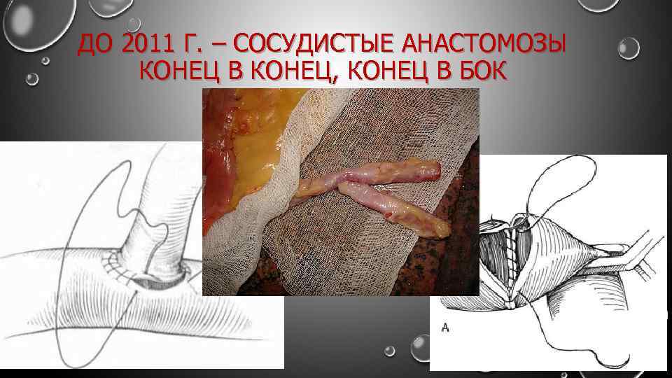 ДО 2011 Г. – СОСУДИСТЫЕ АНАСТОМОЗЫ КОНЕЦ В КОНЕЦ, КОНЕЦ В БОК 