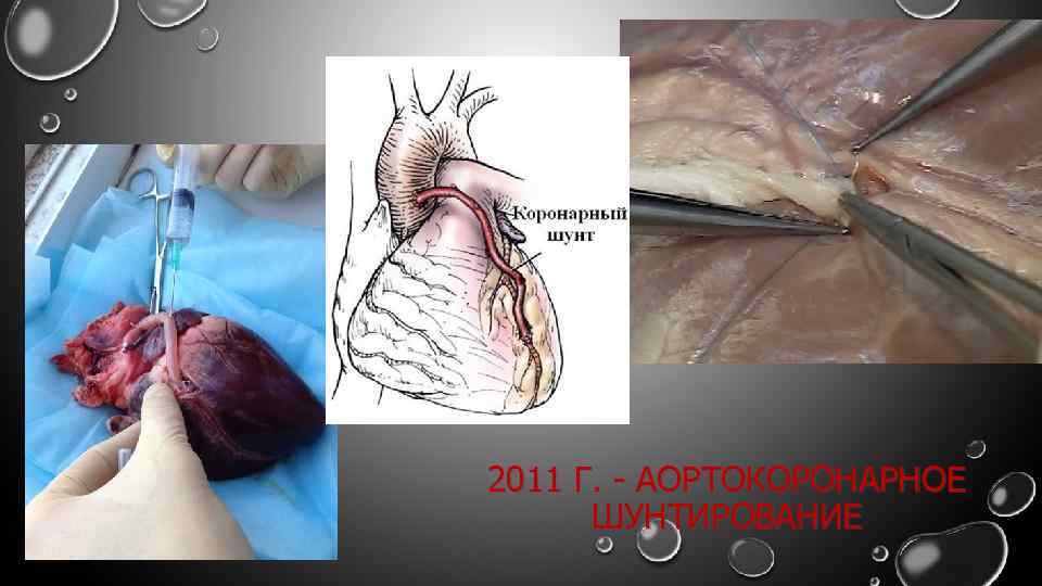 2011 Г. - АОРТОКОРОНАРНОЕ ШУНТИРОВАНИЕ 