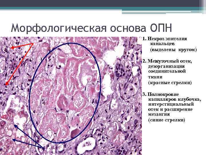 Морфологическая основа ОПН 1. Некроз эпителия канальцев (выделены кругом) 2. Межуточный отек, дезорганизация соединительной