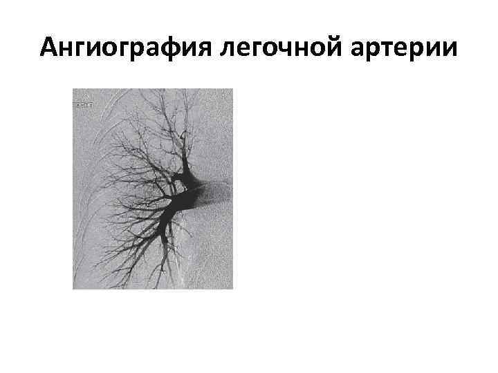 Ангиография легочной артерии 