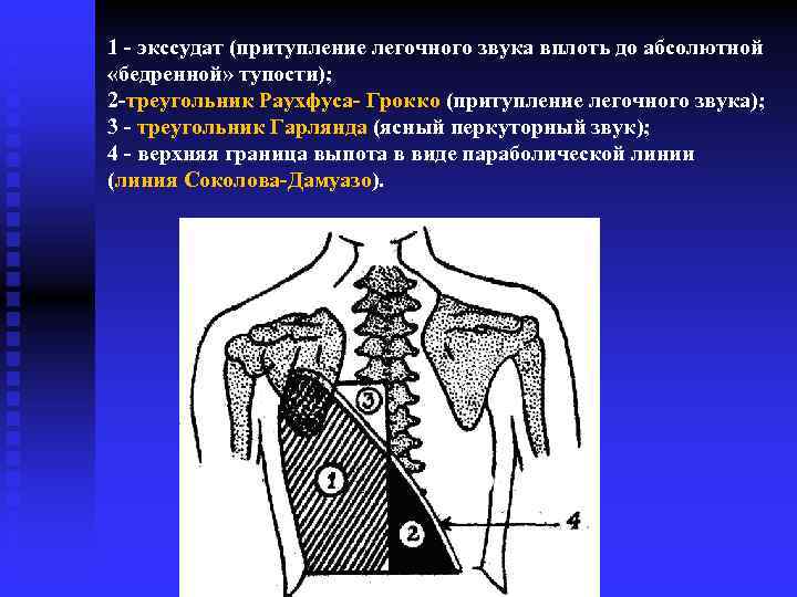 1 экссудат (притупление легочного звука вплоть до абсолютной «бедренной» тупости); 2 треугольник Раухфуса Грокко