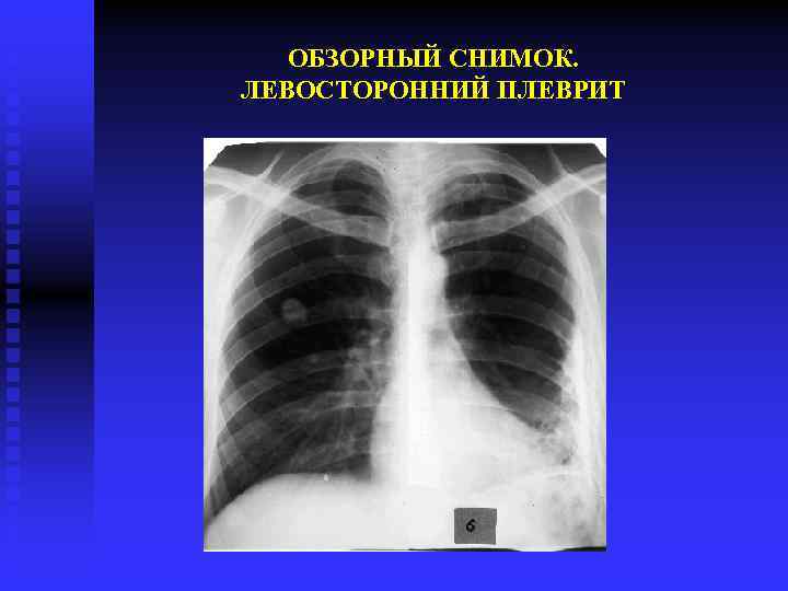 Обзорный снимок. Травматический плеврит. Левосторонний плеврит. Левосторонний сухой плеврит.